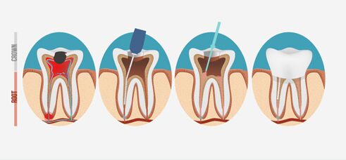 Root Canal Dentist in Tempe, AZ, Top-Rated Endodontis Near Me